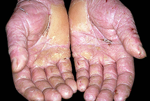 Dermatitis Showing Crusting and Thickening of the Skin - Photo credits – Contains public sector information published by the Health and Safety Executive and licensed under the Open Government Licence v1.0